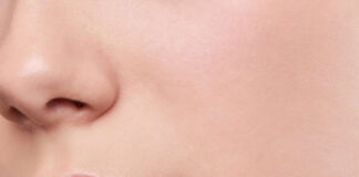 Lip Lift